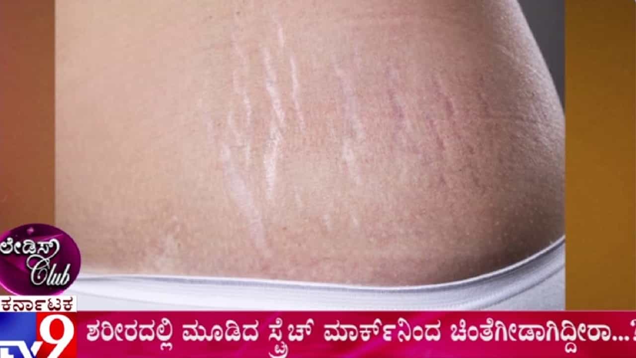 ಸ್ಟ್ರೆಚ್ ಮಾರ್ಕ್ ನಿವಾರಣೆಗೆ ಸರಳ ಉಪಾಯ! ಸ್ಟ್ರೆಚ್ ಮಾರ್ಕ್ ನಿವಾರಣೆಗೆ ಸರಳ ಉಪಾಯ!