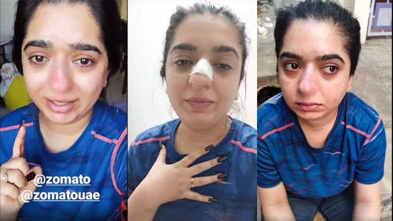 ನಿಗದಿತ ಸಮಯಕ್ಕೆ ಬಾರದ ಊಟ; ಪ್ರಶ್ನಿಸಿದ್ದಕ್ಕೆ ಯುವತಿಯ ಮೂಗು ಮುರಿದ ಜೊಮ್ಯಾಟೋ ಡೆಲಿವರಿ ಬಾಯ್