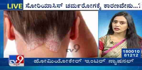 ನಮ್ಮ  ಡಾಕ್ಟರ್: ಸೋರಿಯಾಸಿಸ್​ಗೆ ಹೋಮಿಯೋಪಥಿ ಚಿಕಿತ್ಸೆ ಹೋಮಿಯೋಕೇರ್​ ಇಂಟರ್​​ನ್ಯಾಷನಲ್​ ಅವರಿಂದ