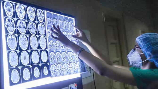 Alzheimer's Disease ಅಲ್ಜೈಮರ್ ಕಾಯಿಲೆಯ ಹೊಸ ಔಷಧಿಗೆ ಎಫ್​ಡಿಎ ಅನುಮೋದನೆ
