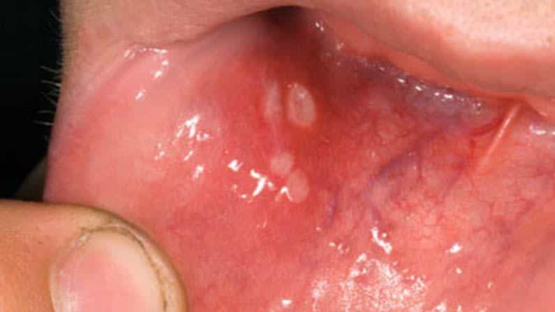 Mouth Ulcers: ಬಾಯಿ ಹುಣ್ಣಿನಿಂದ ಬಳಲುತ್ತಿದ್ದೀರಾ? ಈ ಸರಳ ವಿಧಾನವನ್ನು ಅನುಸರಿಸಿ ನೋವಿನಿಂದ ಮುಕ್ತಿ ಪಡೆಯಿರಿ Mouth Ulcers: ಬಾಯಿ ಹುಣ್ಣಿನಿಂದ ಬಳಲುತ್ತಿದ್ದೀರಾ? ಈ ಸರಳ ವಿಧಾನವನ್ನು ಅನುಸರಿಸಿ ನೋವಿನಿಂದ ಮುಕ್ತಿ ಪಡೆಯಿರಿ
