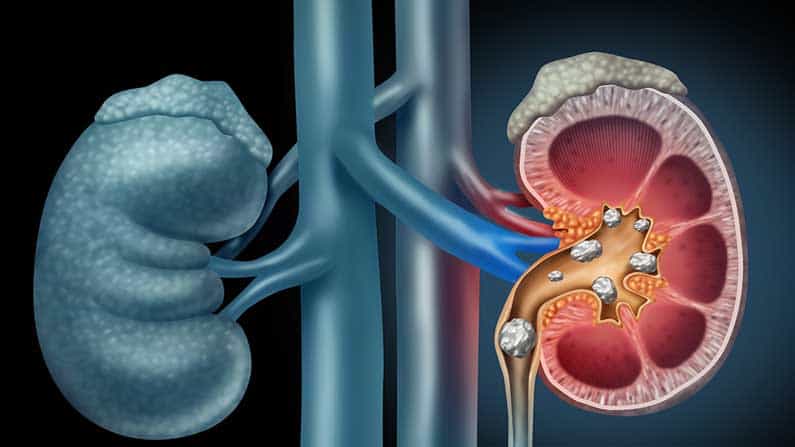 Health Tips: ಕಿಡ್ನಿ ಸ್ಟೋನ್ ಸಮಸ್ಯೆಯ ಲಕ್ಷಣಗಳೇನು? ಪರಿಹಾರಗಳಿವೆಯಾ? Health Tips: ಕಿಡ್ನಿ ಸ್ಟೋನ್ ಸಮಸ್ಯೆಯ ಲಕ್ಷಣಗಳೇನು? ಪರಿಹಾರಗಳಿವೆಯಾ?