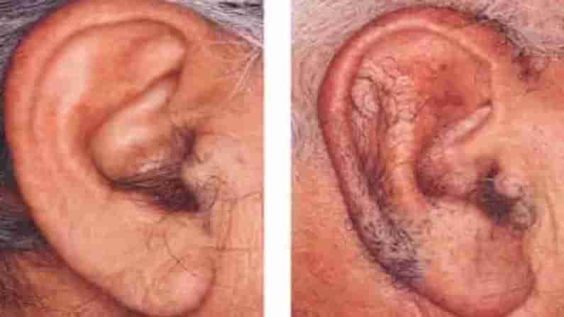 Hairy Ears: ಕಿವಿಯಲ್ಲಿ ಬೆಳೆಯುವ ಕೂದಲು ಆರೋಗ್ಯಕ್ಕೆ ಹಾನಿಕಾರಕವೇ?