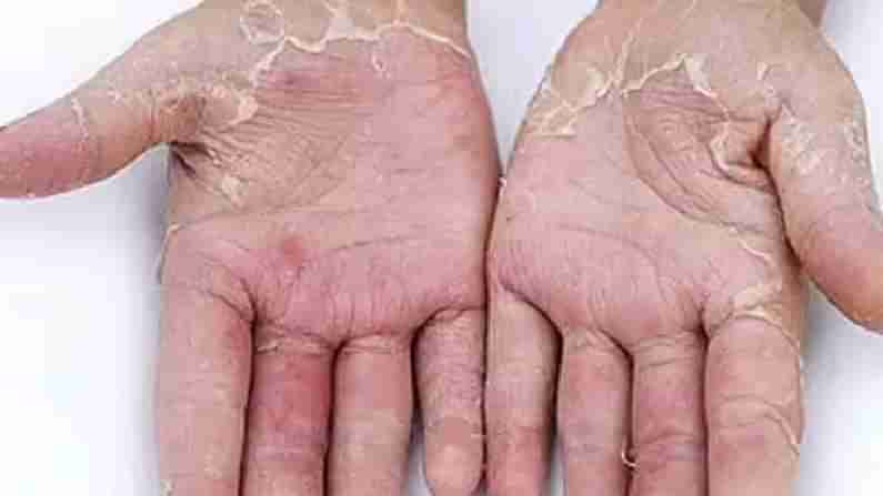 Skin Peeling: ಅಂಗೈಯ ಚರ್ಮ ಸುಲಿದಂತೆ ಭಾಸವಾಗುತ್ತಿದೆ? ಇಲ್ಲಿದೆ ಅದಕ್ಕೆ ಪರಿಹಾರ