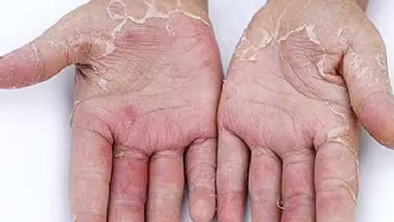 Skin Peeling: ಅಂಗೈಯ ಚರ್ಮ ಸುಲಿದಂತೆ ಭಾಸವಾಗುತ್ತಿದೆ? ಇಲ್ಲಿದೆ ಅದಕ್ಕೆ ಪರಿಹಾರ