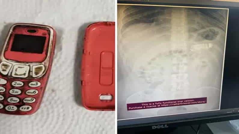 Viral News: ನೊಕಿಯಾ ಮೊಬೈಲ್ ಸೆಟ್ ನುಂಗಿದ ಯುವಕ; ಶಸ್ತ್ರಚಿಕಿತ್ಸೆ ಮಾಡಿ ಪ್ರಾಣಾಪಾಯದಿಂದ ಪಾರು ಮಾಡಿದ ವೈದ್ಯರು