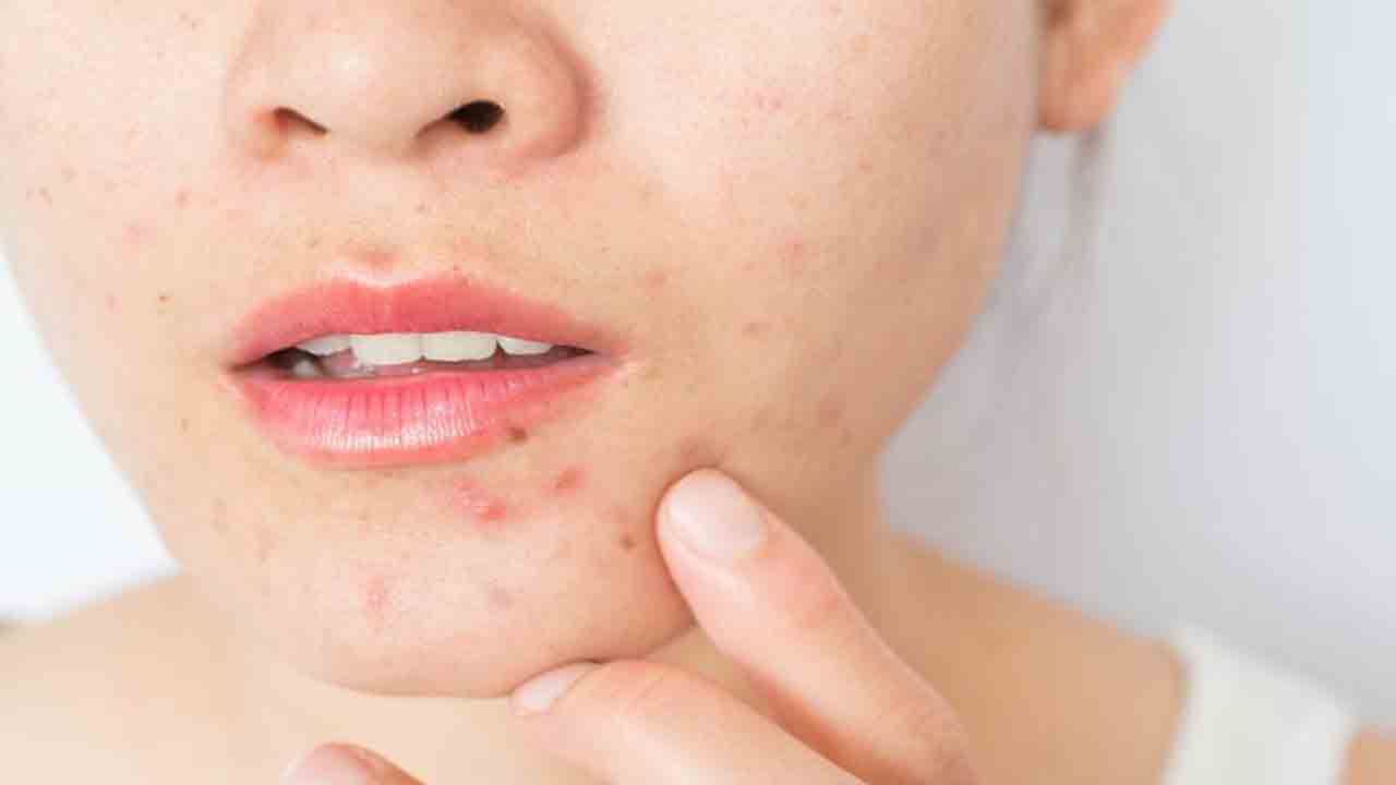 Pimples: ನಿಮ್ಮ ಮುಖದ ಅಂದವನ್ನು ಕಿತ್ತುಕೊಂಡ ಮೊಡವೆ ಸಮಸ್ಯೆಯನ್ನು ಹೋಗಲಾಡಿಸಲು ಕೆಲವು ಟಿಪ್ಸ್ಗಳು ನಿಮಗಾಗಿ