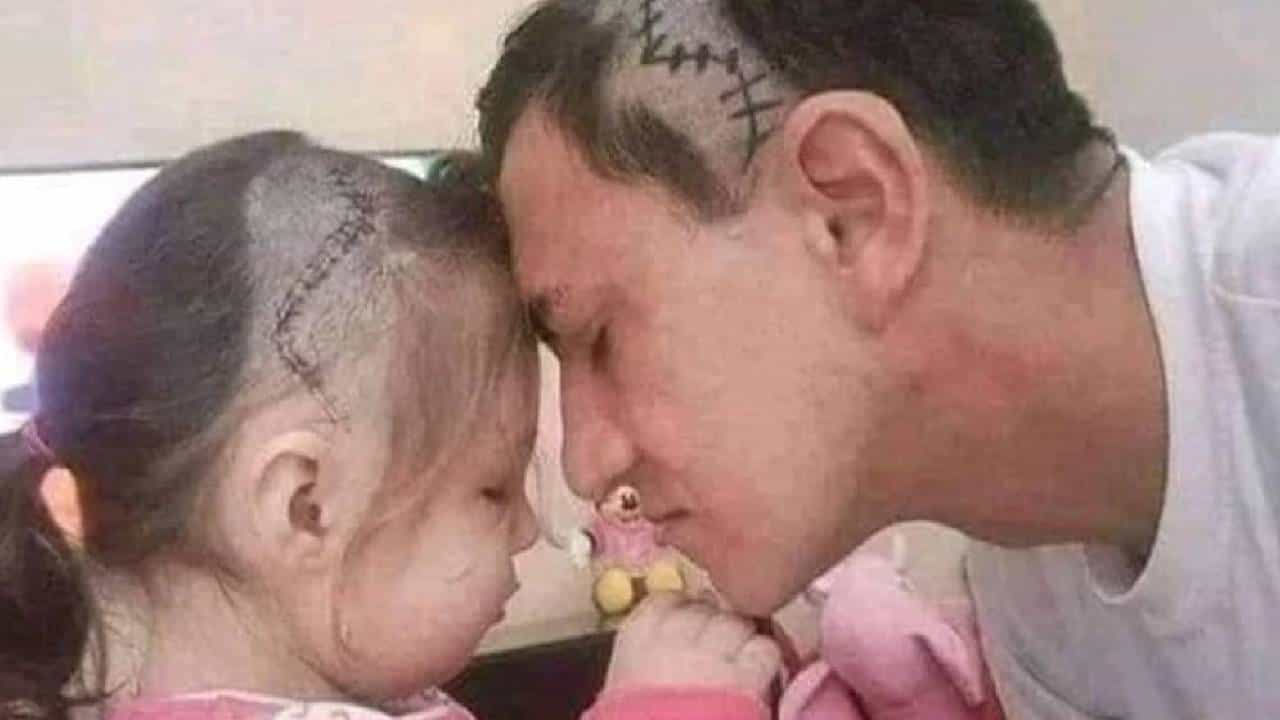 Viral Post; ಮಗಳ ತಲೆಯ ಮೇಲಿನ ಹೊಲಿಗೆಯ ಆಕಾರದಲ್ಲಿ ಹೇರ್ಕಟ್ ಮಾಡಿಸಿಕೊಂಡ ತಂದೆ Viral Post; ಮಗಳ ತಲೆಯ ಮೇಲಿನ ಹೊಲಿಗೆಯ ಆಕಾರದಲ್ಲಿ ಹೇರ್ಕಟ್ ಮಾಡಿಸಿಕೊಂಡ ತಂದೆ