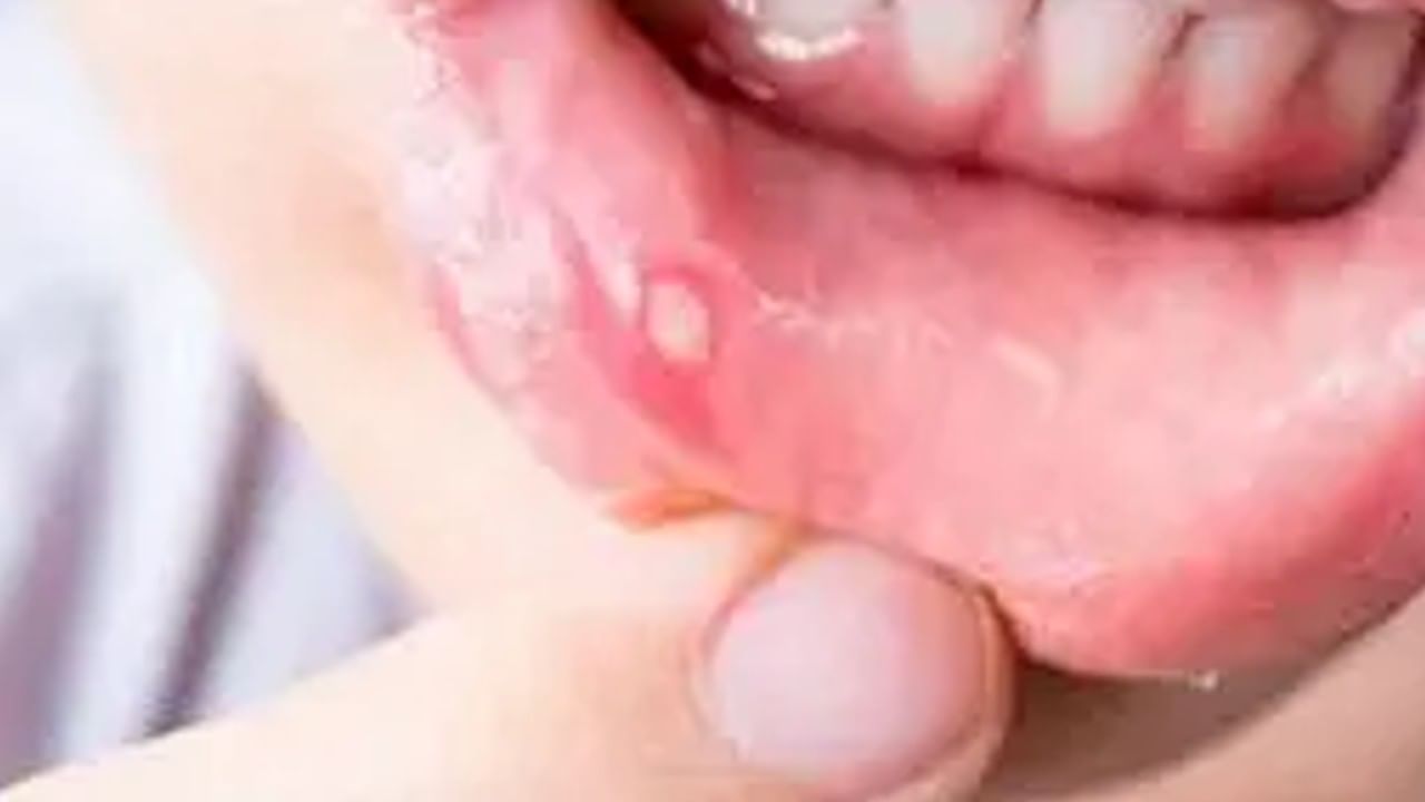 mouth ulcers: ಕಾಡುವ ಬಾಯಿ ಹುಣ್ಣಿನ ಸಮಸ್ಯೆಗೆ ಇಲ್ಲಿವೆ ಸಿಂಪಲ್​ ಮನೆಮದ್ದು