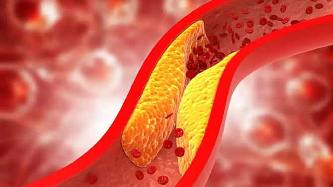 Hypercholesterolemia: ಅಧಿಕ ಕೊಲೆಸ್ಟ್ರಾಲ್​ ಮಟ್ಟವನ್ನು ಸುಧಾರಿಸಲು ಇಲ್ಲಿವೆ ಸರಳ ಸಲಹೆಗಳು