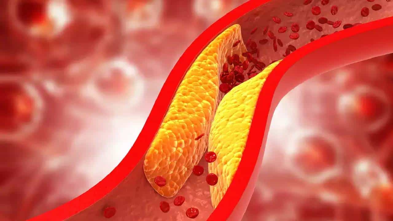 Hypercholesterolemia: ಅಧಿಕ ಕೊಲೆಸ್ಟ್ರಾಲ್ ಮಟ್ಟವನ್ನು ಸುಧಾರಿಸಲು ಇಲ್ಲಿವೆ ಸರಳ ಸಲಹೆಗಳು Hypercholesterolemia: ಅಧಿಕ ಕೊಲೆಸ್ಟ್ರಾಲ್ ಮಟ್ಟವನ್ನು ಸುಧಾರಿಸಲು ಇಲ್ಲಿವೆ ಸರಳ ಸಲಹೆಗಳು