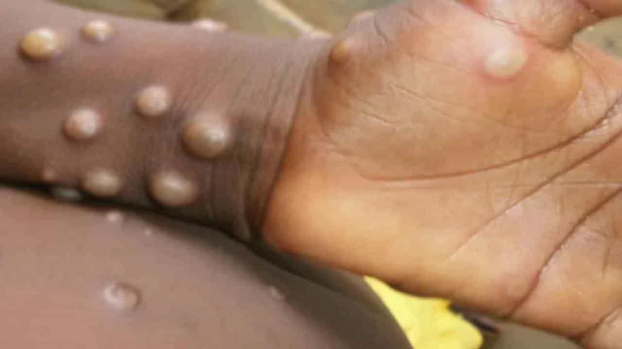 Monkeypox ಮಂಕಿಪಾಕ್ಸ್ ಎದುರಿಸಲು ಭಾರತ ಸಿದ್ಧ ಎಂದ ಐಸಿಎಂಆರ್; ಸಾಮೂಹಿಕ ಲಸಿಕೆ ಅಗತ್ಯವಿಲ್ಲ: ವಿಶ್ವ ಆರೋಗ್ಯ ಸಂಸ್ಥೆ Monkeypox ಮಂಕಿಪಾಕ್ಸ್ ಎದುರಿಸಲು ಭಾರತ ಸಿದ್ಧ ಎಂದ ಐಸಿಎಂಆರ್; ಸಾಮೂಹಿಕ ಲಸಿಕೆ ಅಗತ್ಯವಿಲ್ಲ: ವಿಶ್ವ ಆರೋಗ್ಯ ಸಂಸ್ಥೆ