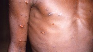 Monkeypox: ಬೆಲ್ಜಿಯಂನಲ್ಲಿ ನಾಲ್ಕು ಮಂಕಿಪಾಕ್ಸ್ ಪ್ರಕರಣಗಳು ಪತ್ತೆ | ರೋಗಿಗಳಿಗೆ 21 ದಿನಗಳ ಕಾಲ ಕ್ವಾರಂಟೈನ್