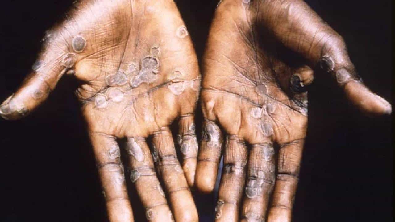 Monkeypox: ಇಂಗ್ಲೆಂಡ್​ನಲ್ಲಿ 36 ಹೊಸ ಮಂಕಿಪಾಕ್ಸ್​ ವೈರಸ್ ಪತ್ತೆ; ಲೈಂಗಿಕ ಕ್ರಿಯೆಯಿಂದಲೂ ಹರಡುತ್ತಂತೆ ಈ ರೋಗ!