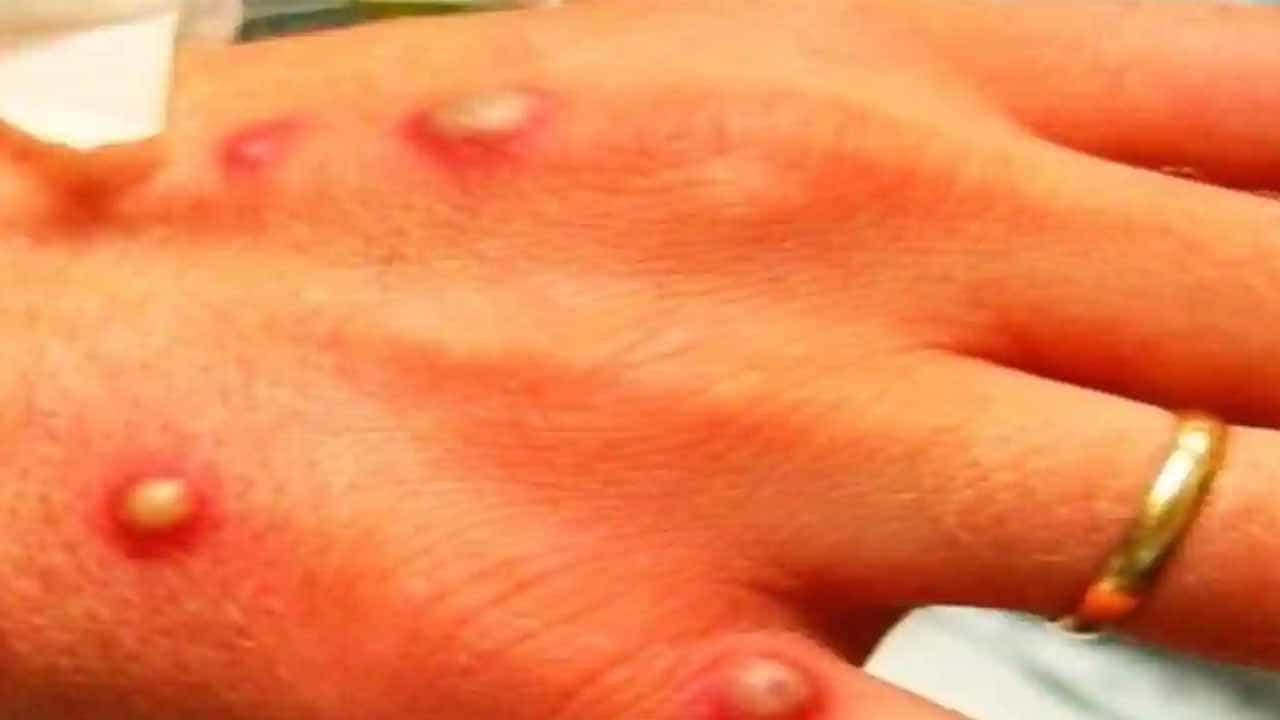 Monkeypox: ಬನ್ನೇರುಘಟ್ಟ ಪಾರ್ಕ್ ಸುತ್ತಲಿನ ಜನಕ್ಕೆ ಶುರುವಾಯ್ತು ಮಂಕಿ ಪಾಕ್ಸ್ ಭಯ, ಆರೋಗ್ಯ ಇಲಾಖೆಯಿಂದ ಕಟ್ಟೆಚ್ಚರ Monkeypox: ಬನ್ನೇರುಘಟ್ಟ ಪಾರ್ಕ್ ಸುತ್ತಲಿನ ಜನಕ್ಕೆ ಶುರುವಾಯ್ತು ಮಂಕಿ ಪಾಕ್ಸ್ ಭಯ, ಆರೋಗ್ಯ ಇಲಾಖೆಯಿಂದ ಕಟ್ಟೆಚ್ಚರ