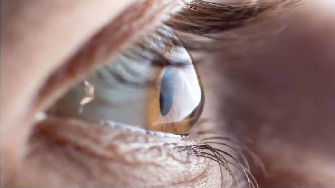 Cataract Eye: ಕಣ್ಣಿನ ಪೊರೆ ಹೋಗಲಾಡಿಸಲು ಶಸ್ತ್ರ ಚಿಕಿತ್ಸೆ ಬೇಡ ಔಷಧಿ ಸಾಕು