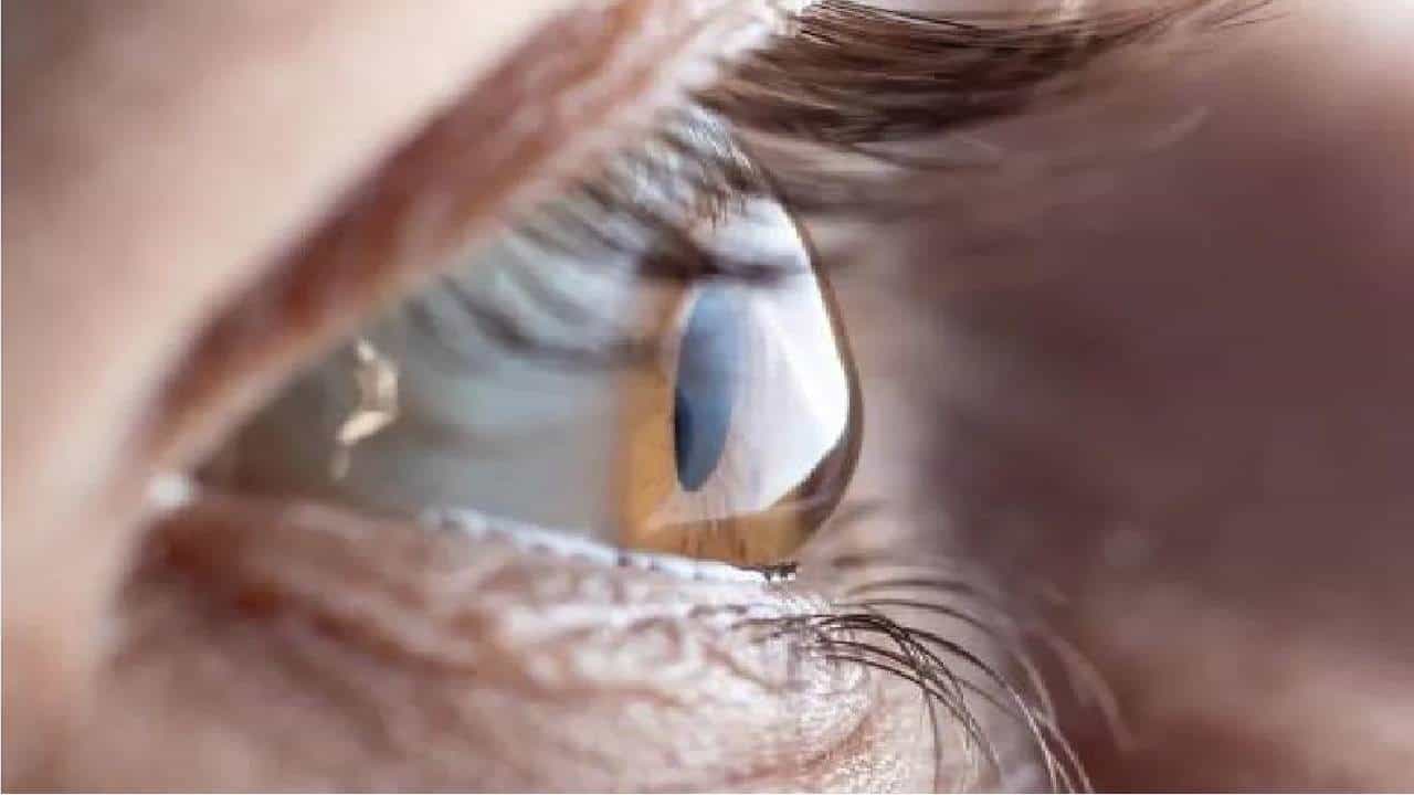 Cataract Eye: ಕಣ್ಣಿನ ಪೊರೆ ಹೋಗಲಾಡಿಸಲು ಶಸ್ತ್ರ ಚಿಕಿತ್ಸೆ ಬೇಡ ಔಷಧಿ ಸಾಕು Cataract Eye: ಕಣ್ಣಿನ ಪೊರೆ ಹೋಗಲಾಡಿಸಲು ಶಸ್ತ್ರ ಚಿಕಿತ್ಸೆ ಬೇಡ ಔಷಧಿ ಸಾಕು