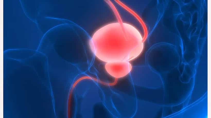 Bladder Cancer: ಮೂತ್ರಕೋಶ ಕ್ಯಾನ್ಸರ್ನ ಲಕ್ಷಣಗಳೇನು? ಪತ್ತೆ ಹೇಗೆ?