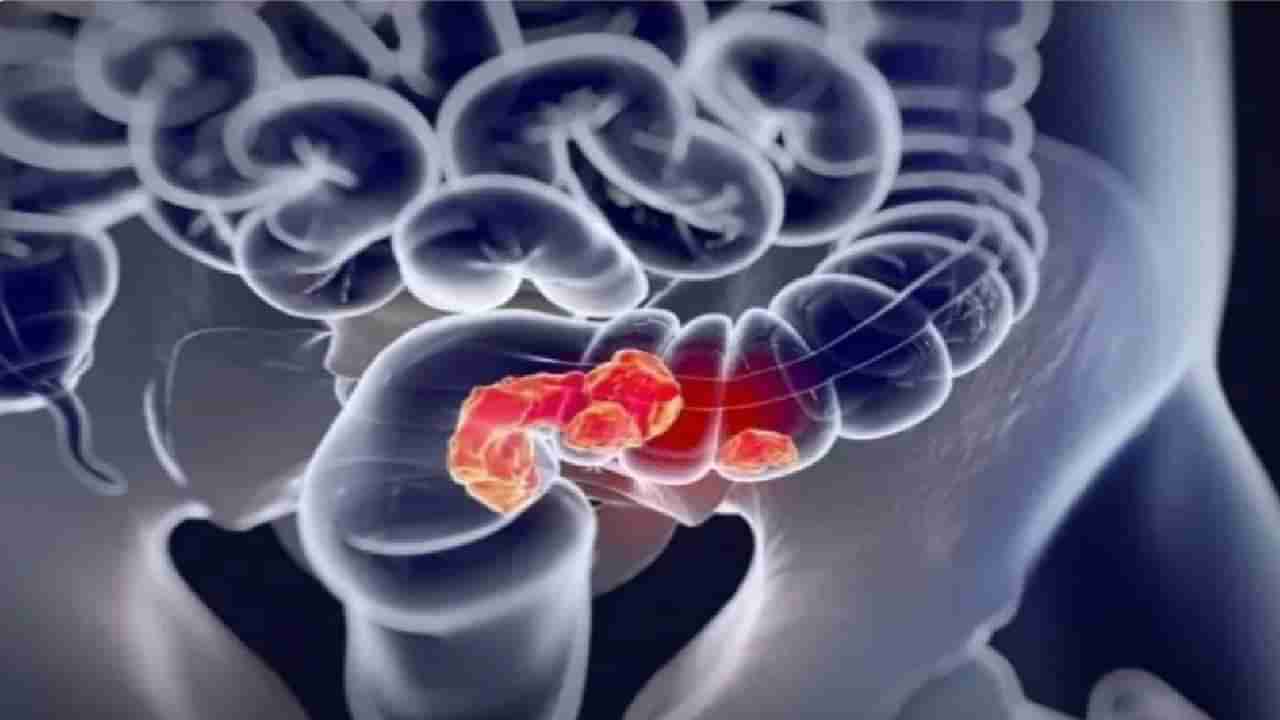 Colorectal Cancer: ಗುದನಾಳದ ಕ್ಯಾನ್ಸರ್ ಎಂದರೇನು? ಲಕ್ಷಣಗಳೇನು? ಡಯಟ್​ನಲ್ಲಿ ಏನಿರಬೇಕು