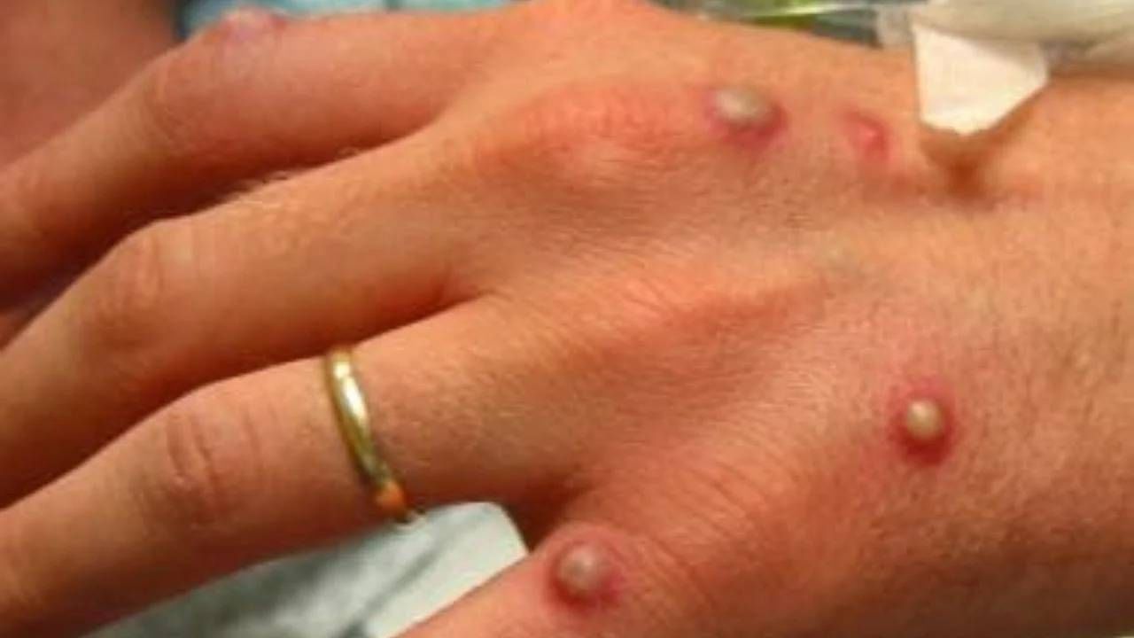Monkeypox: ಟ್ರಾವೆಲ್ ಹಿಸ್ಟರಿಯೇ ಇಲ್ಲದಿದ್ರೂ ಆಫ್ರಿಕಾದ ಹೊರಗೂ ಹಬ್ಬುತ್ತಿದೆ ಮಂಕಿಪಾಕ್ಸ್