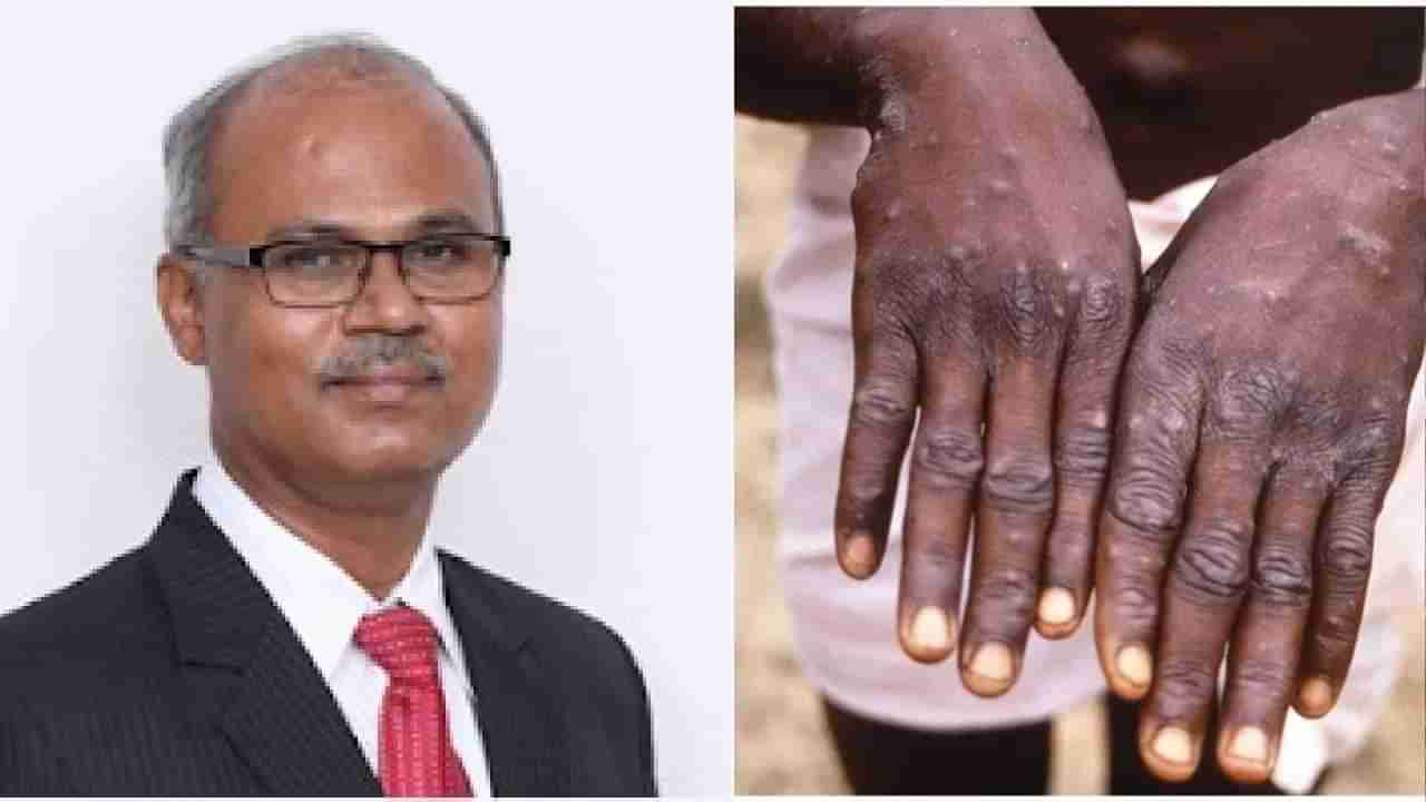 Monkeypox: ಮಂಕಿಪಾಕ್ಸ್​ ವೈರಸ್ ಕುರಿತು ಜನರ ಸಂದೇಹಗಳಿಗೆ ಇಲ್ಲಿದೆ ವೈದ್ಯರಿಂದ ಉತ್ತರ