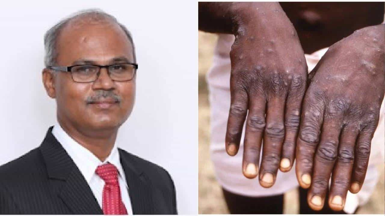 Monkeypox: ಮಂಕಿಪಾಕ್ಸ್ ವೈರಸ್ ಕುರಿತು ಜನರ ಸಂದೇಹಗಳಿಗೆ ಇಲ್ಲಿದೆ ವೈದ್ಯರಿಂದ ಉತ್ತರ Monkeypox: ಮಂಕಿಪಾಕ್ಸ್ ವೈರಸ್ ಕುರಿತು ಜನರ ಸಂದೇಹಗಳಿಗೆ ಇಲ್ಲಿದೆ ವೈದ್ಯರಿಂದ ಉತ್ತರ