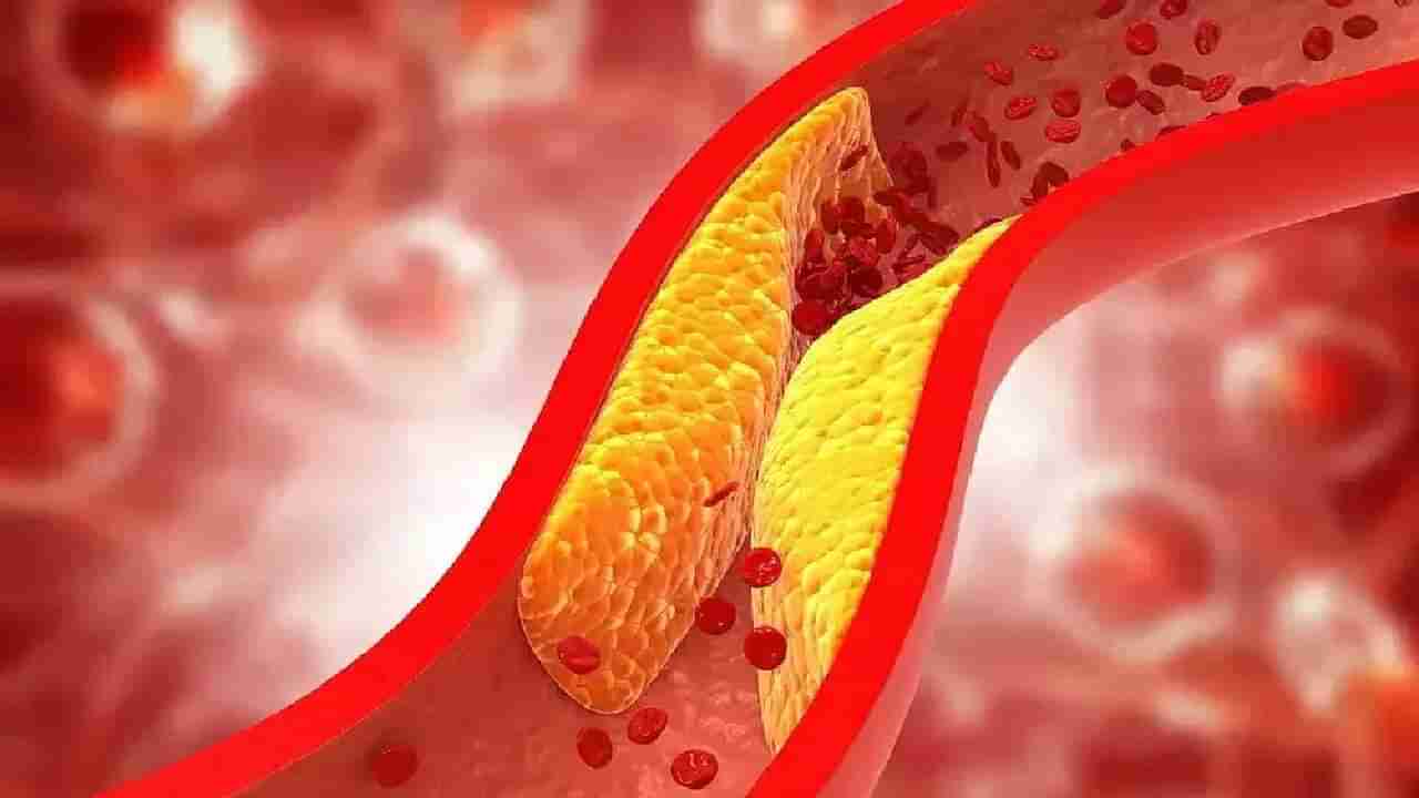 Cholesterol: ನಿಮ್ಮ ದೇಹದಲ್ಲಿ ಕೊಬ್ಬು ಹೆಚ್ಚಾಗಿದೆಯೇ? ತಿಳಿಯುವುದು ಹೇಗೆ?