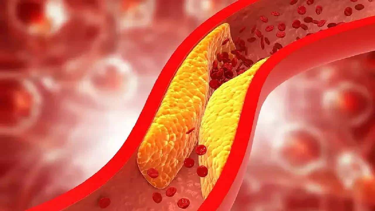 Cholesterol: ನಿಮ್ಮ ದೇಹದಲ್ಲಿ ಕೊಬ್ಬು ಹೆಚ್ಚಾಗಿದೆಯೇ? ತಿಳಿಯುವುದು ಹೇಗೆ? Cholesterol: ನಿಮ್ಮ ದೇಹದಲ್ಲಿ ಕೊಬ್ಬು ಹೆಚ್ಚಾಗಿದೆಯೇ? ತಿಳಿಯುವುದು ಹೇಗೆ?