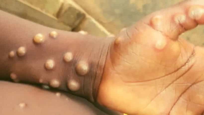 Monkeypox: ಮಂಕಿಪಾಕ್ಸ್ ವೈರಸ್ನಿಂದ ಜಾಗತಿಕ ಆರೋಗ್ಯ ಕ್ಷೇತ್ರಕ್ಕೆ ಅಪಾಯ: WHO