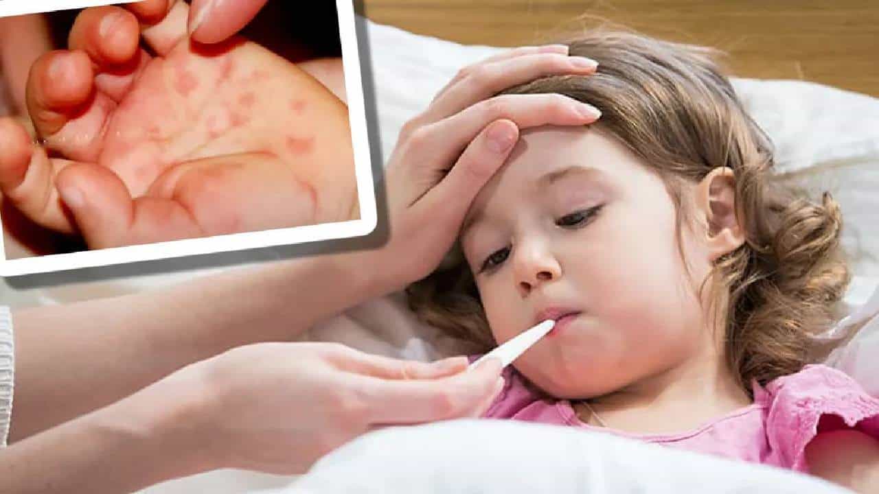 Tomato Flu: ಮಕ್ಕಳನ್ನು ಕಾಡುತ್ತಿರುವ ಟೊಮೆಟೊ ಜ್ವರ ಎಂದರೇನು? ಲಕ್ಷಣಗಳು ಯಾವುವು? Tomato Flu: ಮಕ್ಕಳನ್ನು ಕಾಡುತ್ತಿರುವ ಟೊಮೆಟೊ ಜ್ವರ ಎಂದರೇನು? ಲಕ್ಷಣಗಳು ಯಾವುವು?