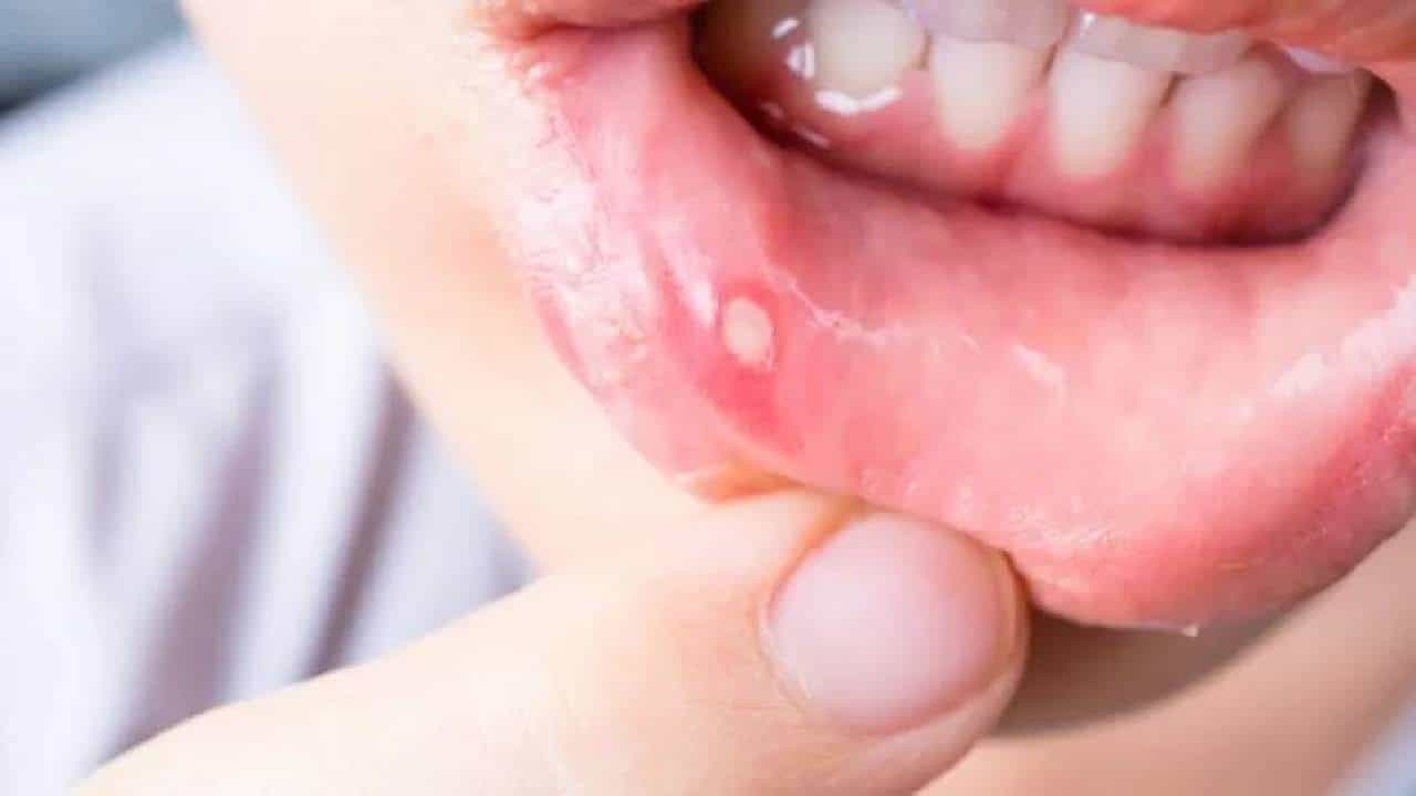 Mouth Sore:ಬಾಯಿ ಹುಣ್ಣಿನ ಬಗ್ಗೆ ನಿರ್ಲಕ್ಷ್ಯ ಬೇಡ, ಕಾರಣ ಹಾಗೂ ಲಕ್ಷಣಗಳೇನು?