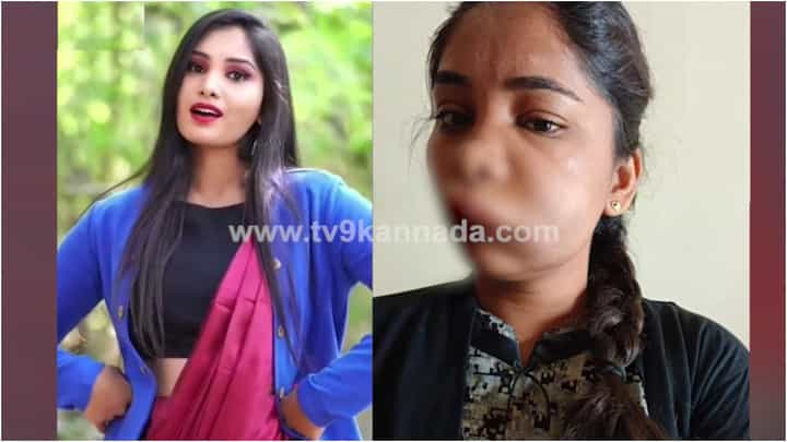ಹಲ್ಲಿನ ಚಿಕಿತ್ಸೆ ಪಡೆದ ಯುವ ನಟಿಗೆ ಇಂಥ ದುಸ್ಥಿತಿ; ವೈದ್ಯರ ಎಡವಟ್ಟಿನಿಂದ ಮುಖ ವಿರೂಪ ಹಲ್ಲಿನ ಚಿಕಿತ್ಸೆ ಪಡೆದ ಯುವ ನಟಿಗೆ ಇಂಥ ದುಸ್ಥಿತಿ; ವೈದ್ಯರ ಎಡವಟ್ಟಿನಿಂದ ಮುಖ ವಿರೂಪ