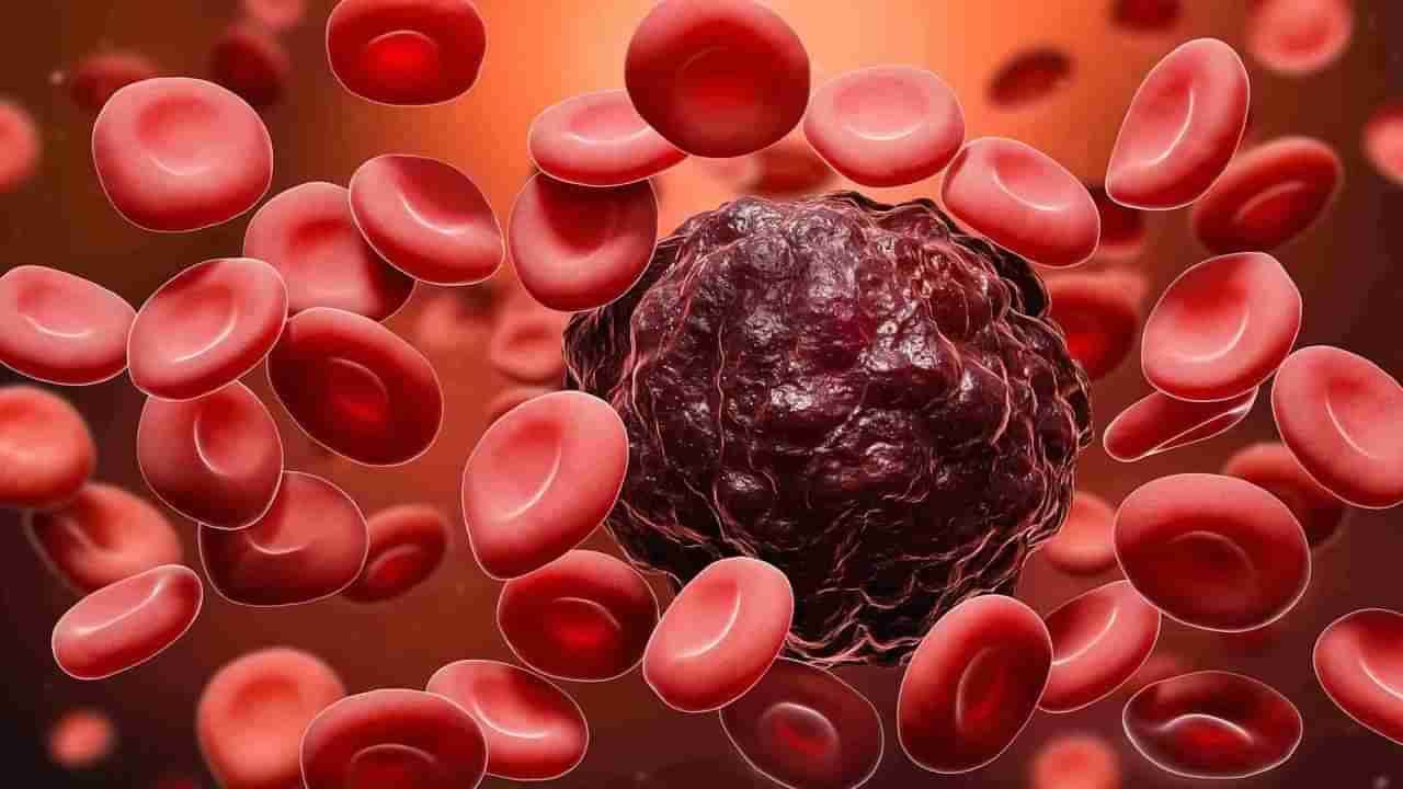 Blood Cancer: ದೀರ್ಘಕಾಲದ ಗಂಟಲು ಕೆರೆತ ಕ್ಯಾನ್ಸರ್​ನ ಲಕ್ಷಣವೇ?