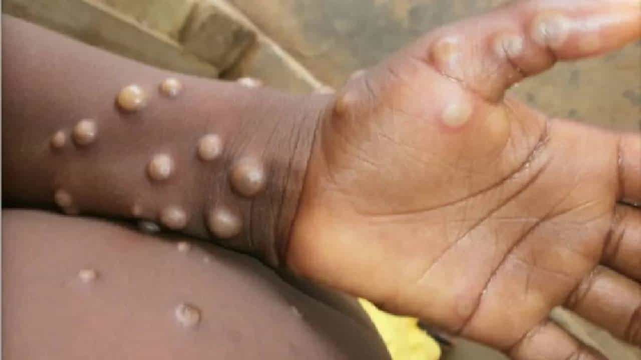 Monkeypox: ಸಮುದಾಯಕ್ಕೆ ಹರಡುತ್ತಿದೆ ಮಂಕಿಪಾಕ್ಸ್, ಮಕ್ಕಳು, ಗರ್ಭಿಣಿಯರಿಗೆ ಅಪಾಯ: WHO Monkeypox: ಸಮುದಾಯಕ್ಕೆ ಹರಡುತ್ತಿದೆ ಮಂಕಿಪಾಕ್ಸ್, ಮಕ್ಕಳು, ಗರ್ಭಿಣಿಯರಿಗೆ ಅಪಾಯ: WHO