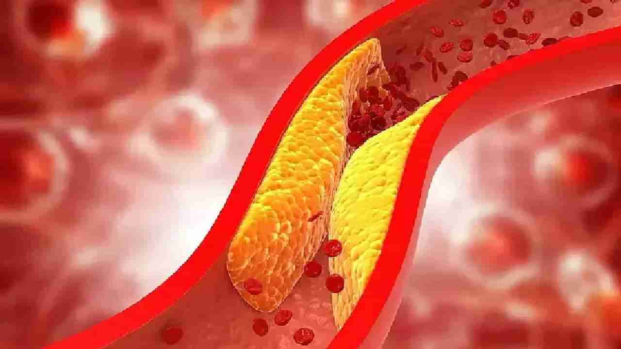 Cholesterol: ನಿಮ್ಮ ದೇಹದಲ್ಲಿ ಕೊಬ್ಬು ಹೆಚ್ಚಾದರೆ ನಿಮ್ಮ ಕಣ್ಣಿನಲ್ಲೇ ತಿಳಿಯುತ್ತೆ ಹೇಗಂತೀರಾ?