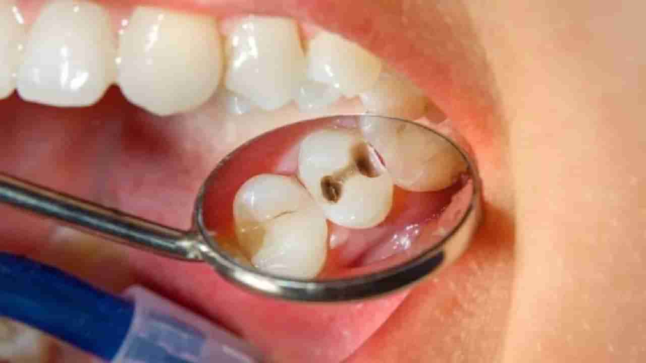 Oral Health: ಹಲ್ಲು ಹುಳುಕಾಗಲು ನಿಮ್ಮ ಈ ಅಭ್ಯಾಸಗಳೇ ಕಾರಣವಾಗಿರಬಹುದು