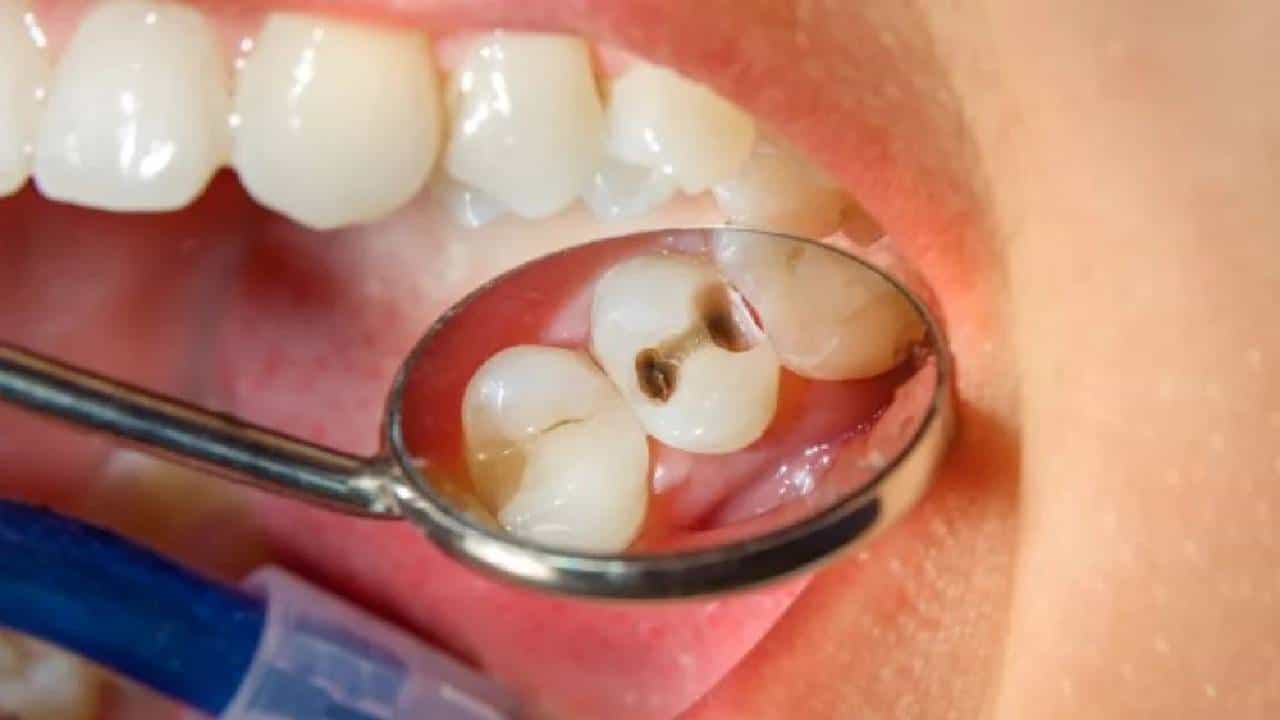 Oral Health: ಹಲ್ಲು ಹುಳುಕಾಗಲು ನಿಮ್ಮ ಈ ಅಭ್ಯಾಸಗಳೇ ಕಾರಣವಾಗಿರಬಹುದು Oral Health: ಹಲ್ಲು ಹುಳುಕಾಗಲು ನಿಮ್ಮ ಈ ಅಭ್ಯಾಸಗಳೇ ಕಾರಣವಾಗಿರಬಹುದು