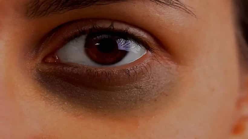 Dark Circles: ನಿಮಗೆ ಡಾರ್ಕ್ಸರ್ಕಲ್ಸ್ ಸಮಸ್ಯೆಯೇ? ಈ ಆಹಾರವನ್ನು ಮಿಸ್ ಮಾಡದೇ ಸೇವಿಸಿ