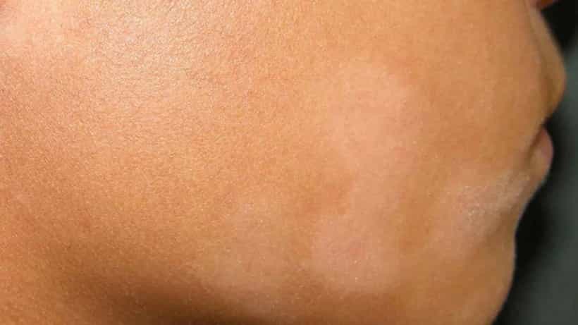 White Spot On Skin: ಮುಖದಲ್ಲಿ ಮೂಡುವ ಬಿಳಿ ಕಲೆಗಳು ಏನನ್ನು ಸೂಚಿಸುತ್ತವೆ?