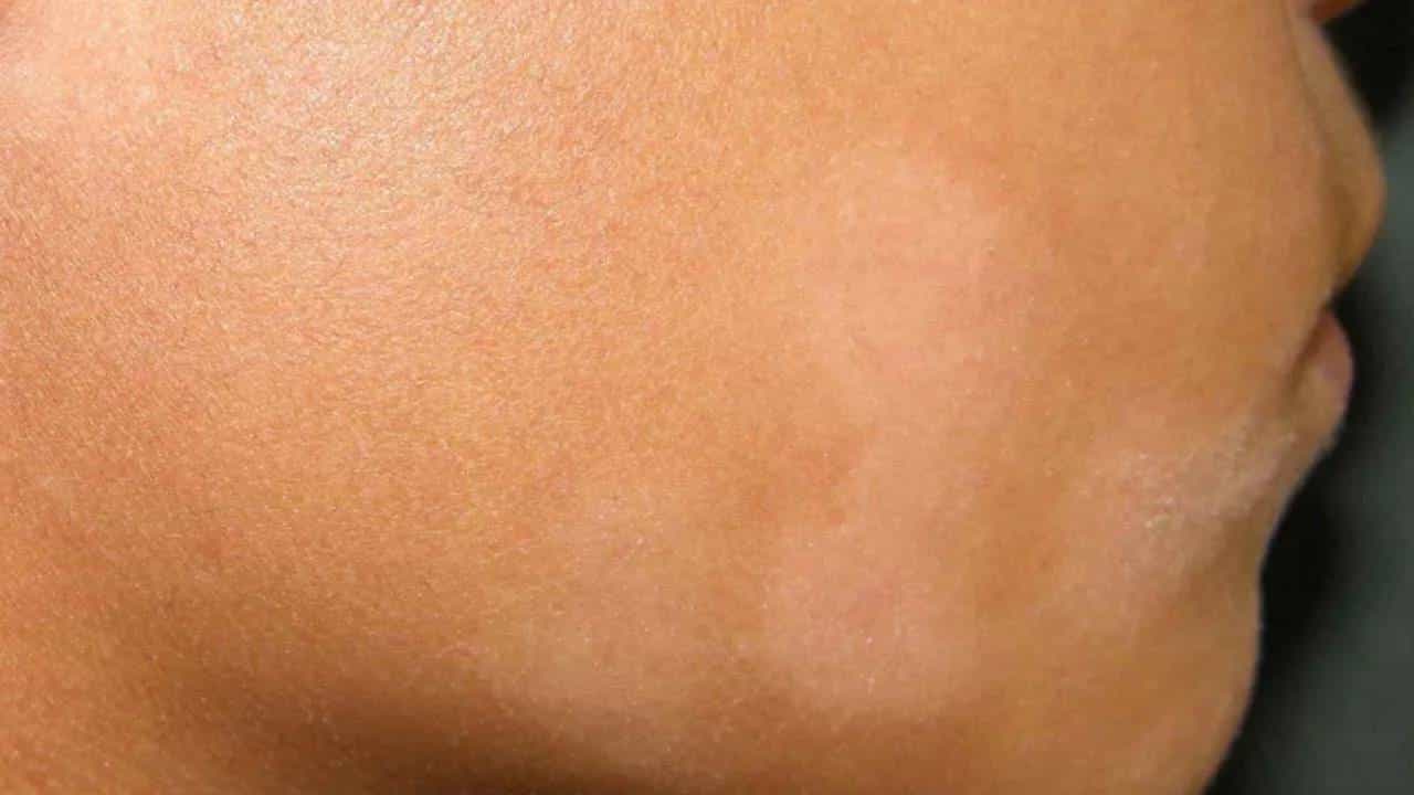 White Spot On Skin: ಮುಖದಲ್ಲಿ ಮೂಡುವ ಬಿಳಿ ಕಲೆಗಳು ಏನನ್ನು ಸೂಚಿಸುತ್ತವೆ? White Spot On Skin: ಮುಖದಲ್ಲಿ ಮೂಡುವ ಬಿಳಿ ಕಲೆಗಳು ಏನನ್ನು ಸೂಚಿಸುತ್ತವೆ?