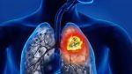 Lung Cancer: ಈ ಲಕ್ಷಣಗಳು ಗೋಚರಿಸಿದರೆ ಕೂಡಲೇ ವೈದ್ಯರನ್ನು ಸಂಪರ್ಕಿಸಿ