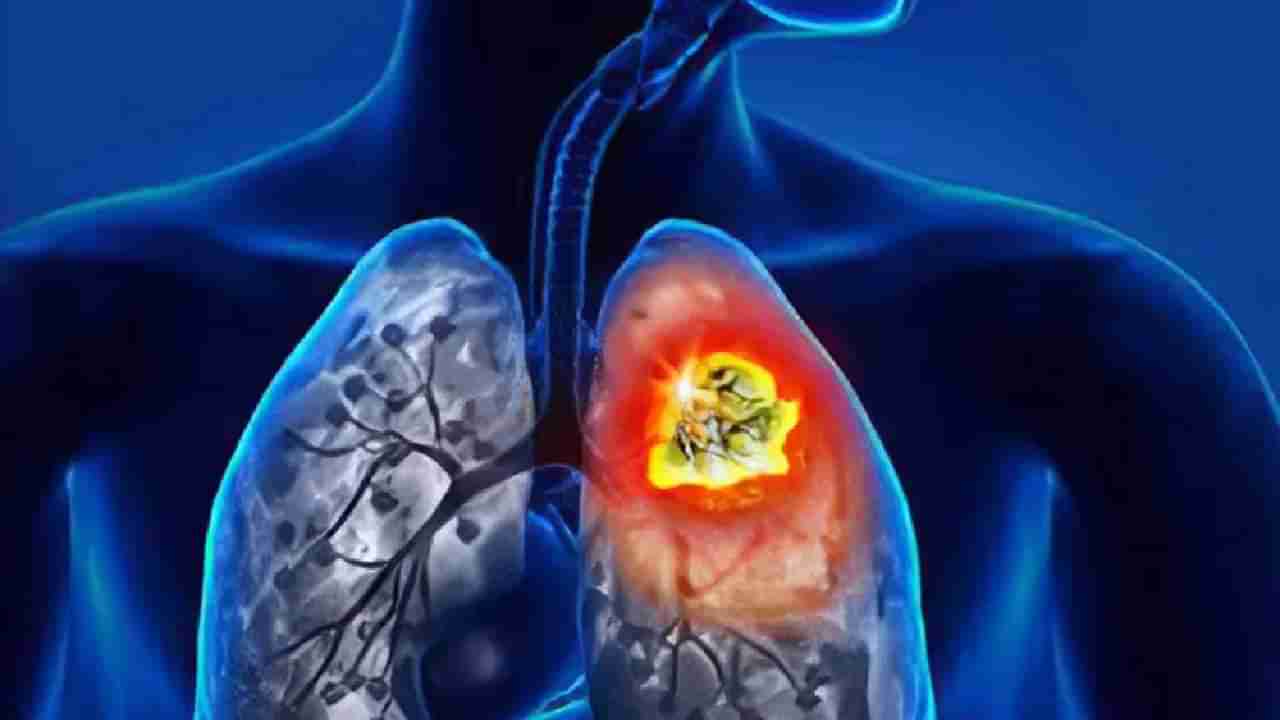 Lung Cancer: ಈ ಲಕ್ಷಣಗಳು ಗೋಚರಿಸಿದರೆ ಕೂಡಲೇ ವೈದ್ಯರನ್ನು ಸಂಪರ್ಕಿಸಿ