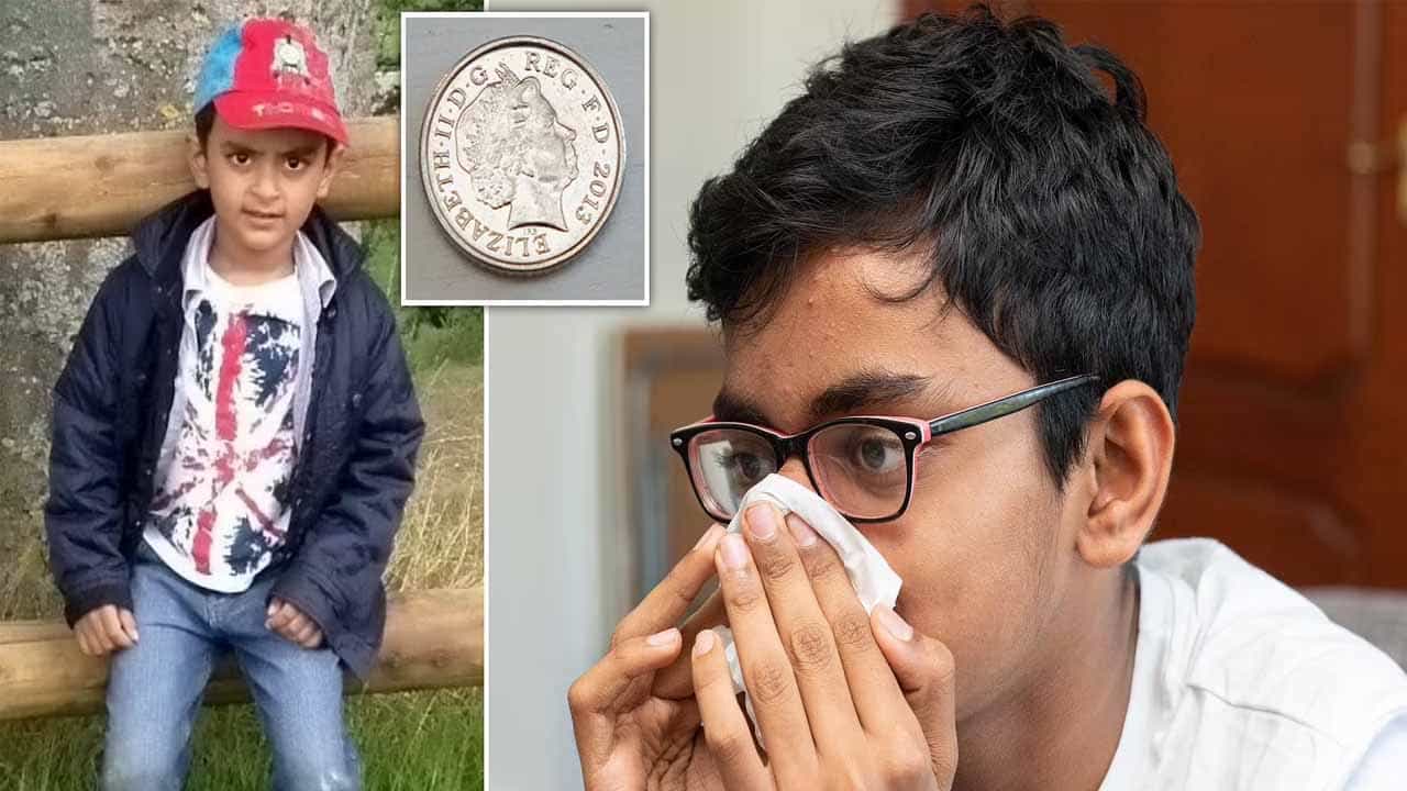 ಯುನೈಟೆಡ್ ಕಿಂಗ್ಡಮ್​ನಲ್ಲಿ ಶಾಲಾ ಬಾಲಕನೊಬ್ಬ 10 ವರ್ಷಗಳ ಹಿಂದೆ ಮೂಗಲ್ಲಿ ತೂರಿಸಿಕೊಂಡಿದ್ದ ನಾಣ್ಯ ಮೊನ್ನೆ ಸೀನಿದಾಗ ಹೊರಬಿದ್ದಿದೆ!