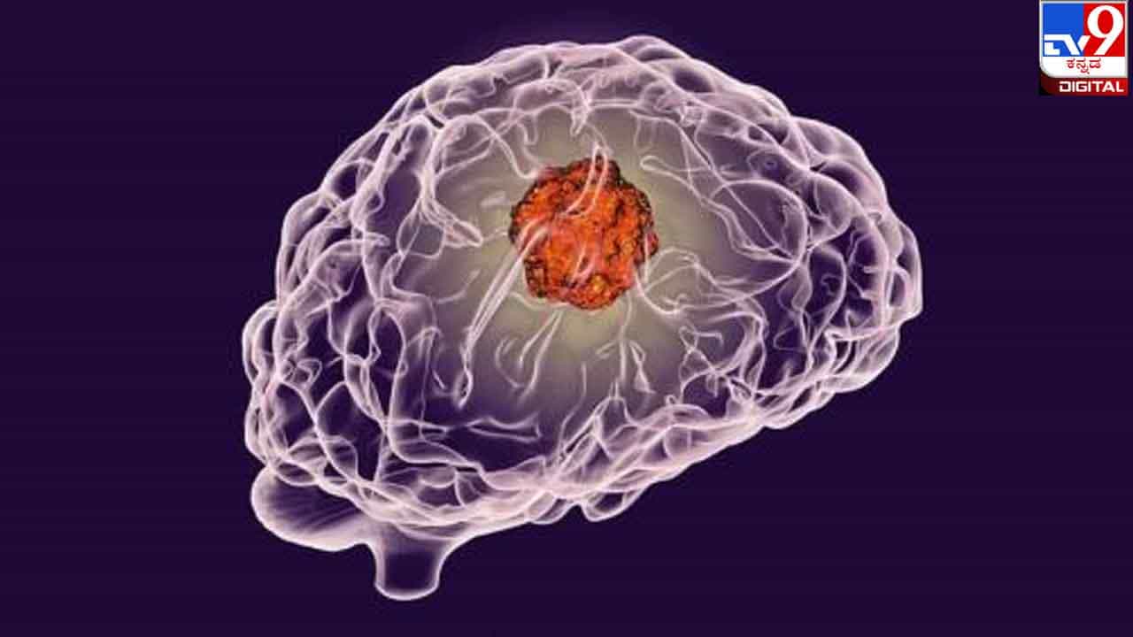 World Brain Tumour Day 2022 : ಬ್ರೇನ್ ಟ್ಯೂಮರ್ಗೆ ಅತಿಯಾದ ತಲೆನೋವೊಂದೇ ಮುಖ್ಯಲಕ್ಷಣವಲ್ಲ World Brain Tumour Day 2022 : ಬ್ರೇನ್ ಟ್ಯೂಮರ್ಗೆ ಅತಿಯಾದ ತಲೆನೋವೊಂದೇ ಮುಖ್ಯಲಕ್ಷಣವಲ್ಲ