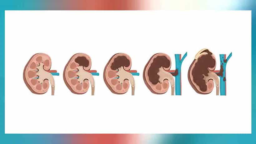 Health : ‘ಕಿಡ್ನಿ ಕ್ಯಾನ್ಸರ್’ ಸದ್ದಿಲ್ಲದೆ ನಿಮ್ಮನ್ನು...