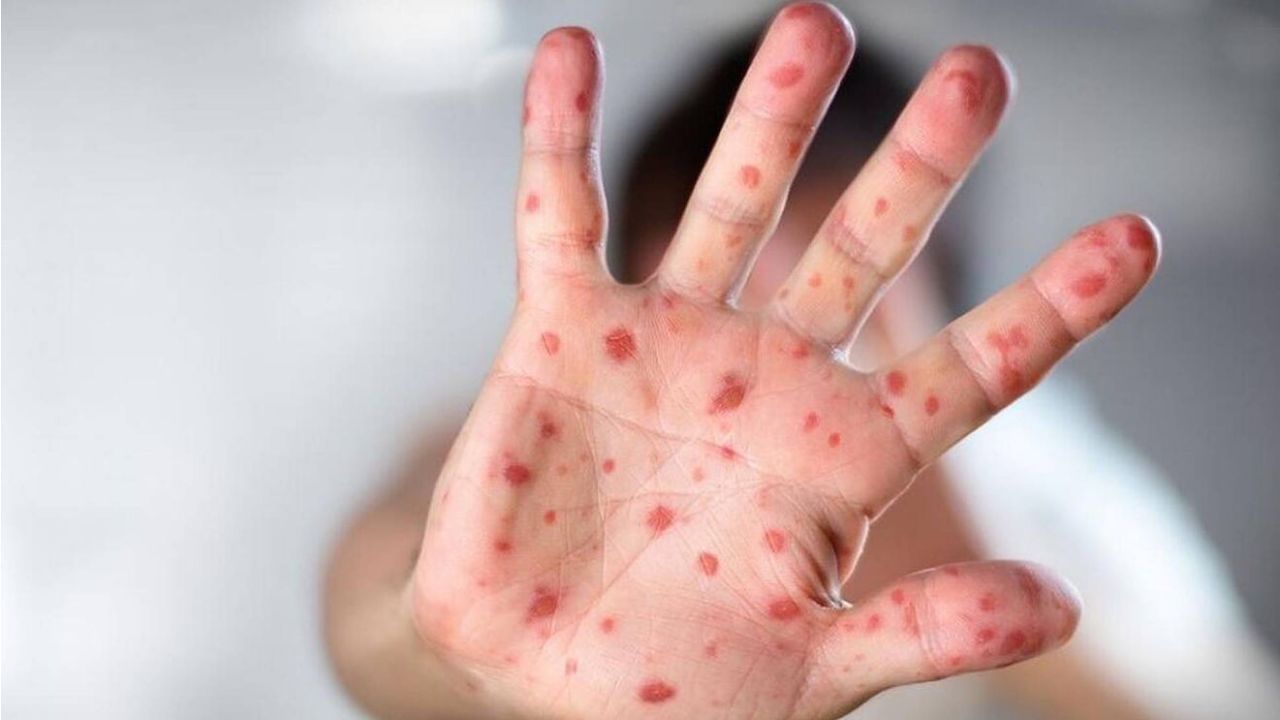 Monkeypox: ಮಂಕಿಪಾಕ್ಸ್​ ರೋಗದ ಲಕ್ಷಣಗಳೇನು? ಯಾವಾಗ ಚಿಕಿತ್ಸೆ ಪಡೆಯಬೇಕು?