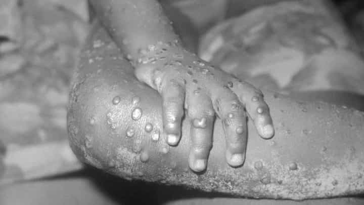 Monkeypox: ಮಂಕಿಪಾಕ್ಸ್ ಮಹಾಮಾರಿಯೇ? ಟಿವಿ 9 ಡಿಜಿಟಲ್ ಲೈವ್ನಲ್ಲಿ ಚರ್ಚೆ Monkeypox: ಮಂಕಿಪಾಕ್ಸ್ ಮಹಾಮಾರಿಯೇ? ಟಿವಿ 9 ಡಿಜಿಟಲ್ ಲೈವ್ನಲ್ಲಿ ಚರ್ಚೆ