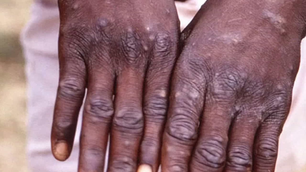 Monkeypox ಮಂಕಿಪಾಕ್ಸ್ ಕಾಯಿಲೆ ಬಗ್ಗೆ ಮಾರ್ಗಸೂಚಿ ಪ್ರಕಟಿಸಿದ ಕೇಂದ್ರ ಆರೋಗ್ಯ ಸಚಿವಾಲಯ Monkeypox ಮಂಕಿಪಾಕ್ಸ್ ಕಾಯಿಲೆ ಬಗ್ಗೆ ಮಾರ್ಗಸೂಚಿ ಪ್ರಕಟಿಸಿದ ಕೇಂದ್ರ ಆರೋಗ್ಯ ಸಚಿವಾಲಯ