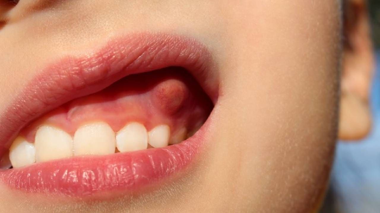 Swollen Gums: ಮಕ್ಕಳ ವಸಡಿನಲ್ಲಿ ಊತ ಕಾಣಿಸಿಕೊಳ್ಳಲು ಕಾರಣಗಳೇನು?