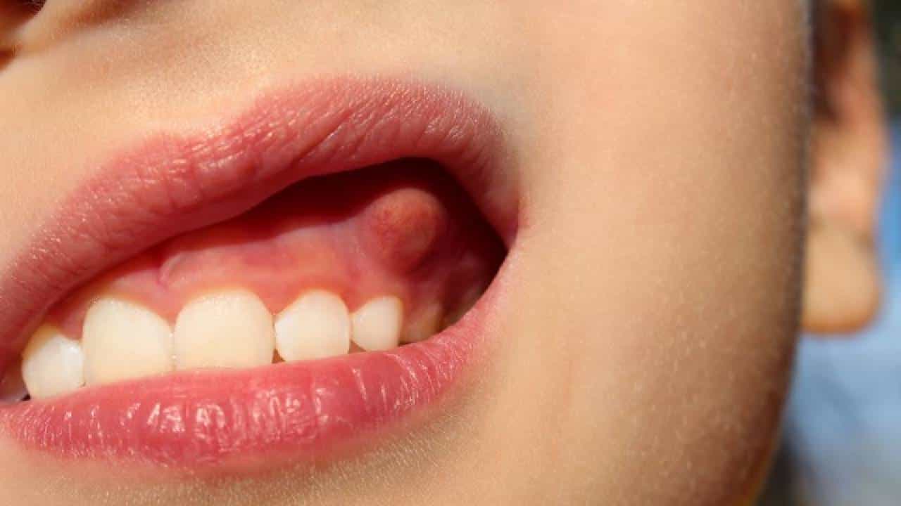 Swollen Gums: ಮಕ್ಕಳ ವಸಡಿನಲ್ಲಿ ಊತ ಕಾಣಿಸಿಕೊಳ್ಳಲು ಕಾರಣಗಳೇನು? Swollen Gums: ಮಕ್ಕಳ ವಸಡಿನಲ್ಲಿ ಊತ ಕಾಣಿಸಿಕೊಳ್ಳಲು ಕಾರಣಗಳೇನು?